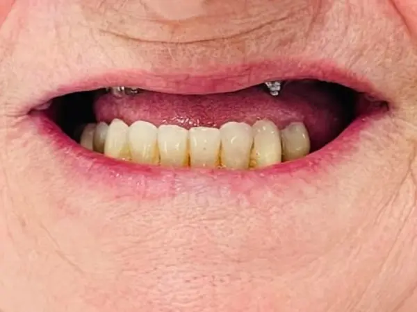Antes del implante dental