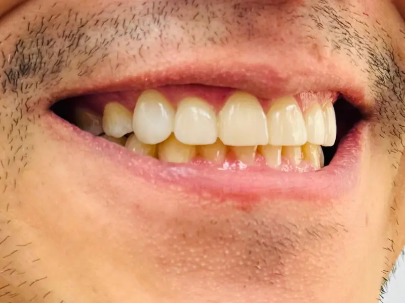 Después del tratamiento: caso de rehabilitación oral