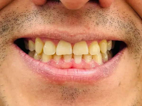 Antes del diseño de sonrisa